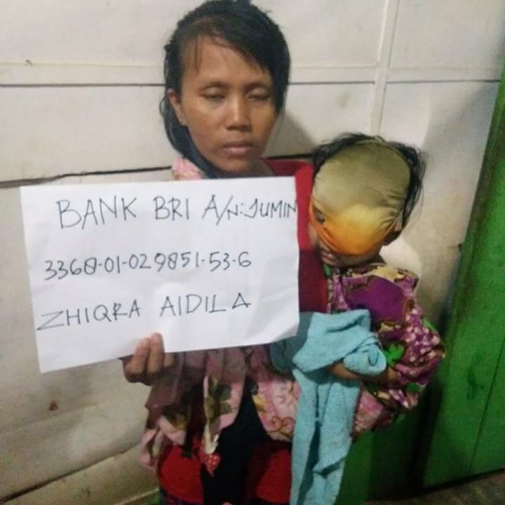 Bupati Rohil Kaget Tak Ada Laporan, Kondisi Bocah Penderita Kanker Mata Memprihatinkan